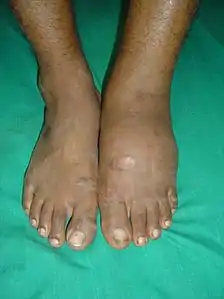 The same 45-year-old man with diabetes mellitus presented with a diffusely swollen, warm and non-tender left foot due to Charcot arthropathy. There are no changes to the skin itself.