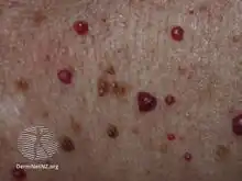 Darker red cherry angioma (direct vision)