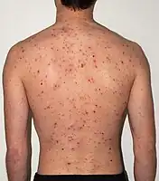 The back of a 30-year-old male after 5 days of the rash