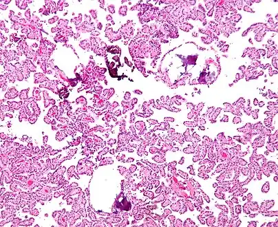 Micrograph of a choroid plexus papilloma. H&E stain.