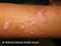 Chronic discoid lupus erythematosus