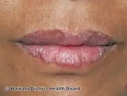 Chronic discoid lupus erythematosus