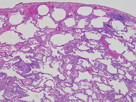 Low magnification view of the histology of chronic hypersensitivity pneumonitis. The interstitium is expanded by a chronic inflammatory infiltrate. Two multinucleated giant cells can be seen within the interstitium at left, and a plug of organizing pneumonia at bottom left.