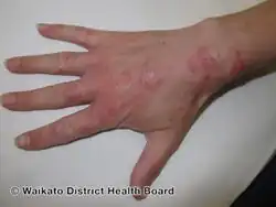 Longterm tinea manuum back of hand