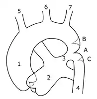 Schematic drawing of alternative locations of a coarctation of the aorta, relative to the ductus arteriosus. A: Ductal coarctation, B: Preductal coarctation, C: Postductal coarctation. 1: Aorta ascendens, 2: Arteria pulmonalis, 3: Ductus arteriosus, 4: Aorta descendens, 5: Truncus brachiocephalicus, 6: Arteria carotis communis sinistra, 7: Arteria subclavia sinistra