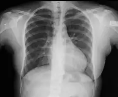 Coarctation of the aorta