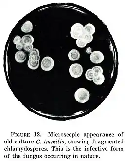 Microscopic appearance of an old culture of Coccidioides immitis, showing fragmented chlamydospores. This is the infective form of the fungus occurring in nature