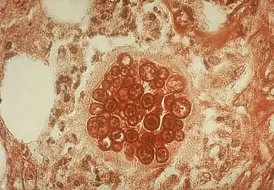 PAS stain of a coccidioidomycosis spherule.