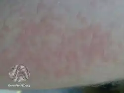 Cold urticaria