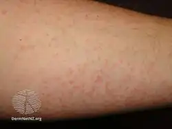 Cold urticaria