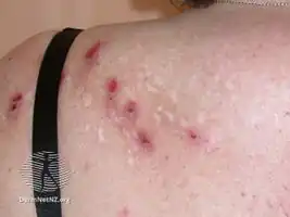 Compulsive skin picking