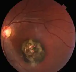 Macular scar