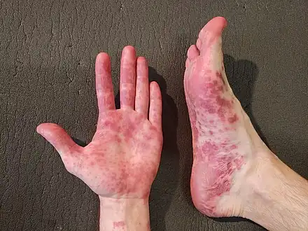 Coxsackievirus infection on skin of adult