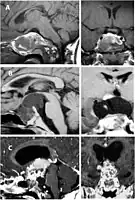 Enhanced T1 weighted MRIs of craniopharyngiomas