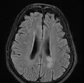 Cryptococcosis brain