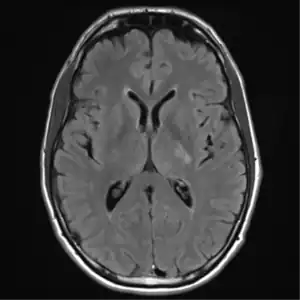 MRI brain: cryptococcus