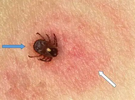 Lone star tick causing Southern tick-associated rash illness, and target erythematous lesion on  right leg