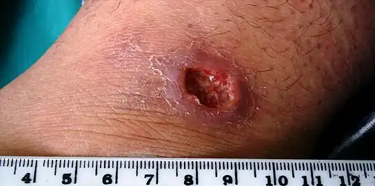 Cutaneous leishmaniasis