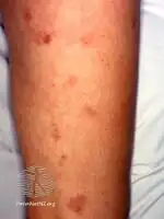 Cutaneous polyarteritis nodosa