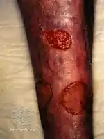 Cutaneous polyarteritis nodosa