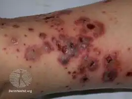 Cutaneous vasculitis