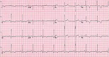 ECG showing HOCM