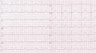 Long QT syndrome