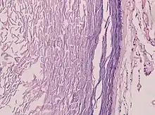 Histopathology showing epithelium and lamellated keratin (left)