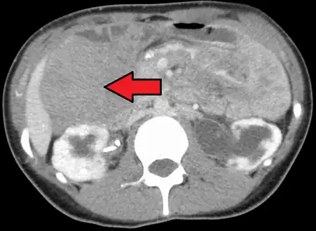 Desmoid tumor