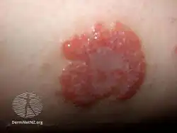 Discoid eczema