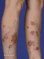 Discoid eczema