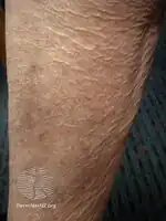 Dry skin