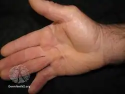 Dupuytren contracture