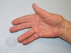 Dupuytren contracture