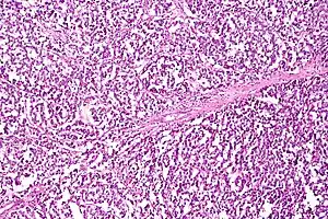 Dysgerminoma characterized by uniform cells separated by fibrous septa with lymphocytes, H&E stain.