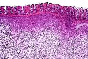 Low-power view of a dysgerminoma infiltrating the colonic wall, H&E stain.