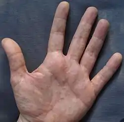 Palmar dyshidrosis