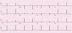 Electrocardiogram (ECG) of a 64-year-old female with sinus bradycardia. Heart rate 49 bpm.