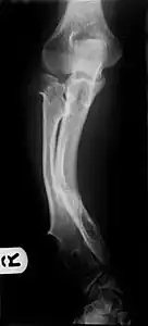 Multiple osteochondromas causing deformity of the forearm (shortening of the Radius with secondary bowing of the Ulna).