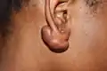 Earlobe aeloid