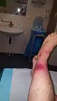 Early symptoms of necrotizing fasciitis. The darker red center is going black.