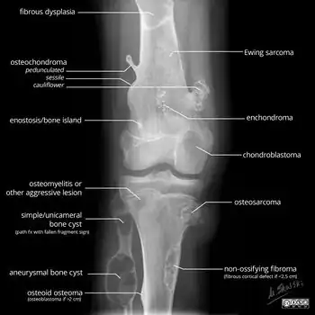 X-ray appearances of different types of bone tumors in < 30 years.