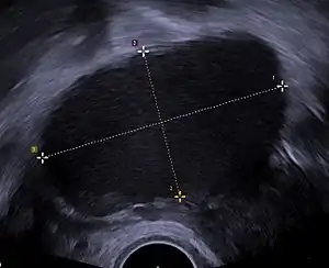 Transvaginal ultrasonography showing a 67 x 40 mm endometrioma, with a somewhat grainy content.