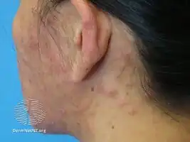 Eosinophilic folliculitis