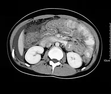 Spiral CT showing ascites and concentric thickening of colon and ileum in EG