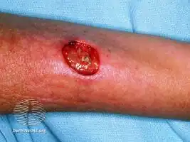 Eosinophilic granulomatosis with polyangiitis