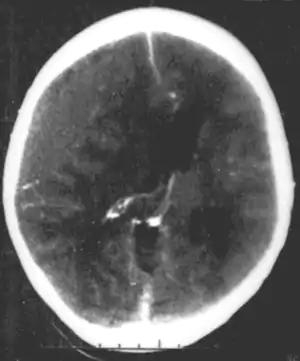 Nontraumatic epidural hematoma in a young woman. The grey area in the top left is organizing hematoma, causing midline shift and compression of the ventricle.