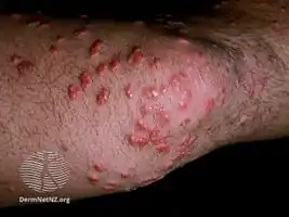 Eruptive xanthoma