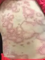 Erythema annulare centrifugum