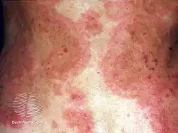 Erythema annulare centrifugum